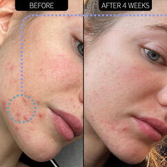 SuperSolutions 2% Novoretin™ Blemish Clearing Moisturiser, , large, image5
