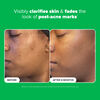 10% Azelaic Acid Booster, , large, image4