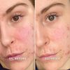 Evercalm™ Redness Relief Serum, , large, image2