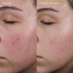 Blemish Control Moisturiser, , large, image3