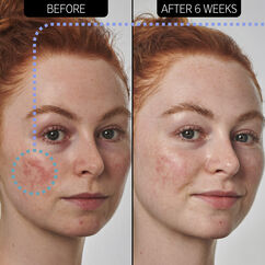 SuperSolutions 10% Azelaic Acid Serum, , large, image4