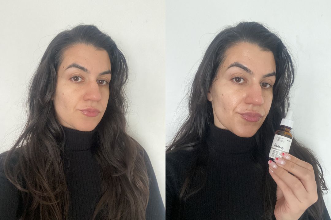 The Ordinary GF 15% Solution Before and After The Ordinary GF 15% Solution Before and After