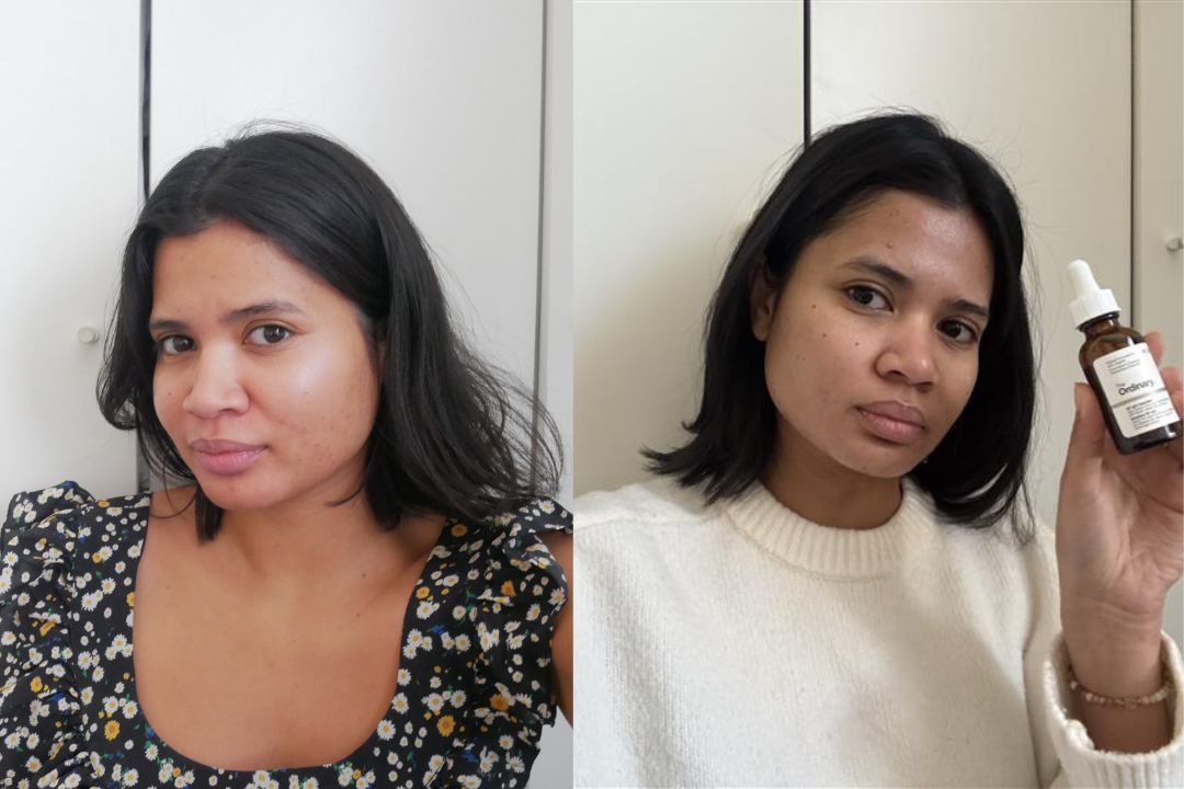 Before and after The Ordinary GF 15% Solution Before and after The Ordinary GF 15% Solution