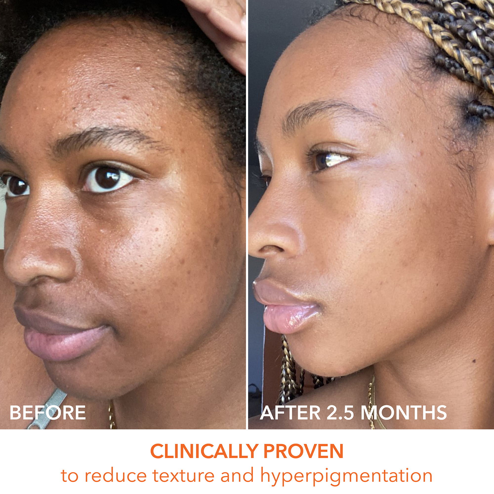 Dr dennis gross peel pads discount